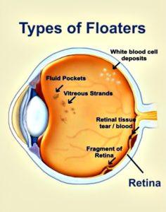 vitreous humor floaters