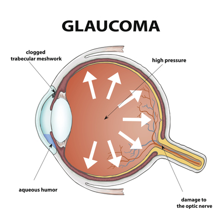 Glaucoma - Symptoms | Causes | Prevention | Happy Eyesight